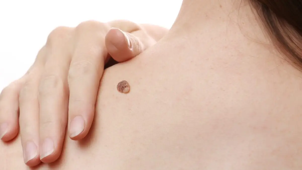 Como eliminar verrugas – Tipos, tratamentos e remédios caseiros