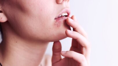 herpes simples