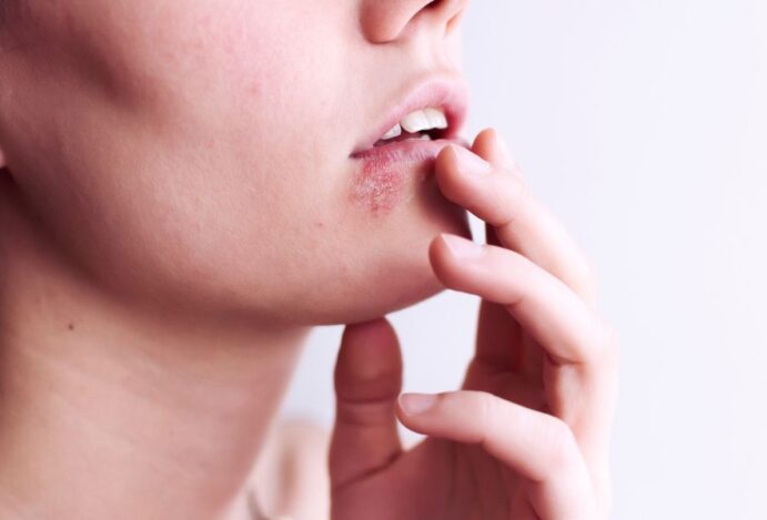 herpes simples