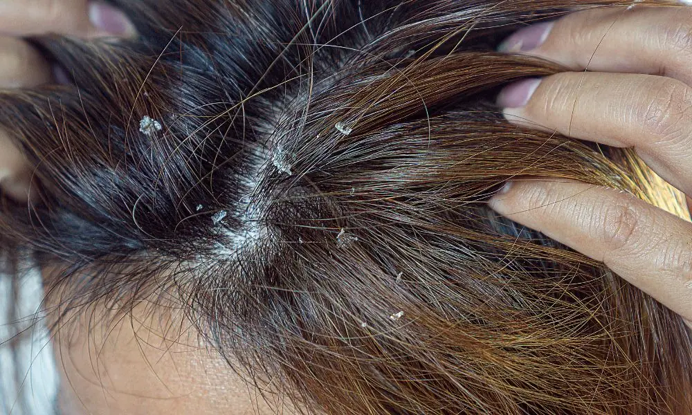 O que é e como tratar a dermatite seborreica no couro cabeludo (1) dermatite seborreica