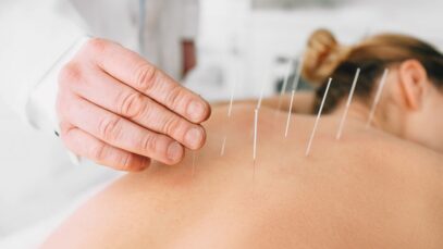 Acupuntura