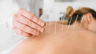 Acupuntura