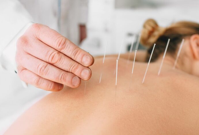 Acupuntura