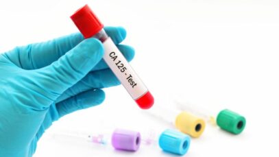 A importância da dosagem da proteína CA 125 no sangue