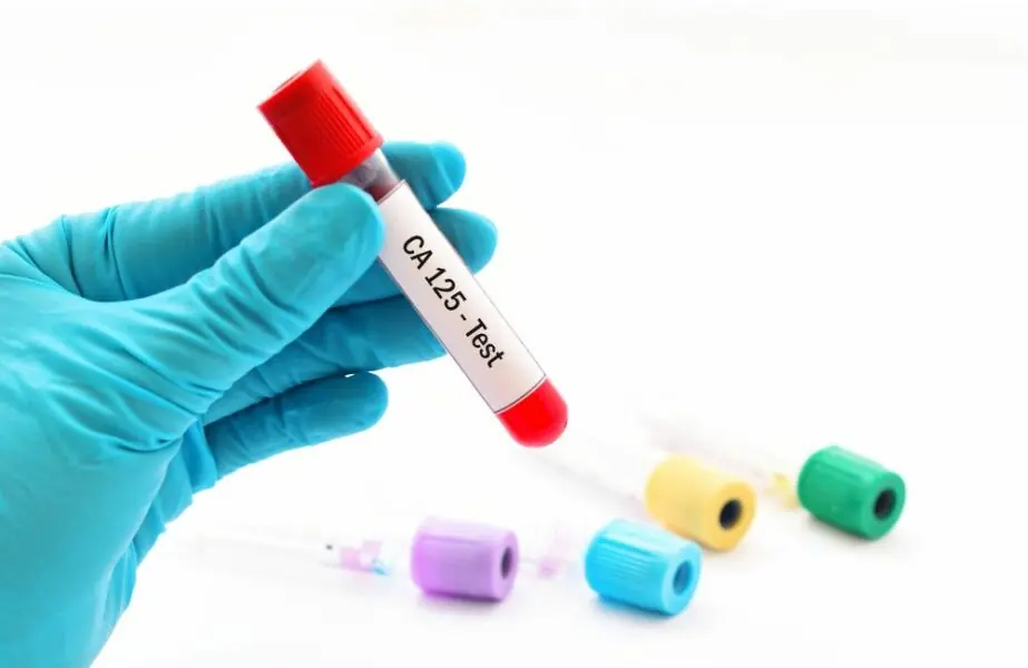 A importância da dosagem da proteína CA 125 no sangue CA 125