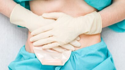 colostomia