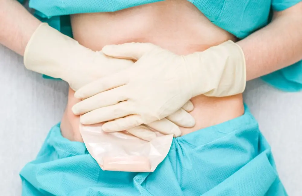 Descubra o que é colostomia e quando o procedimento é indicado colostomia