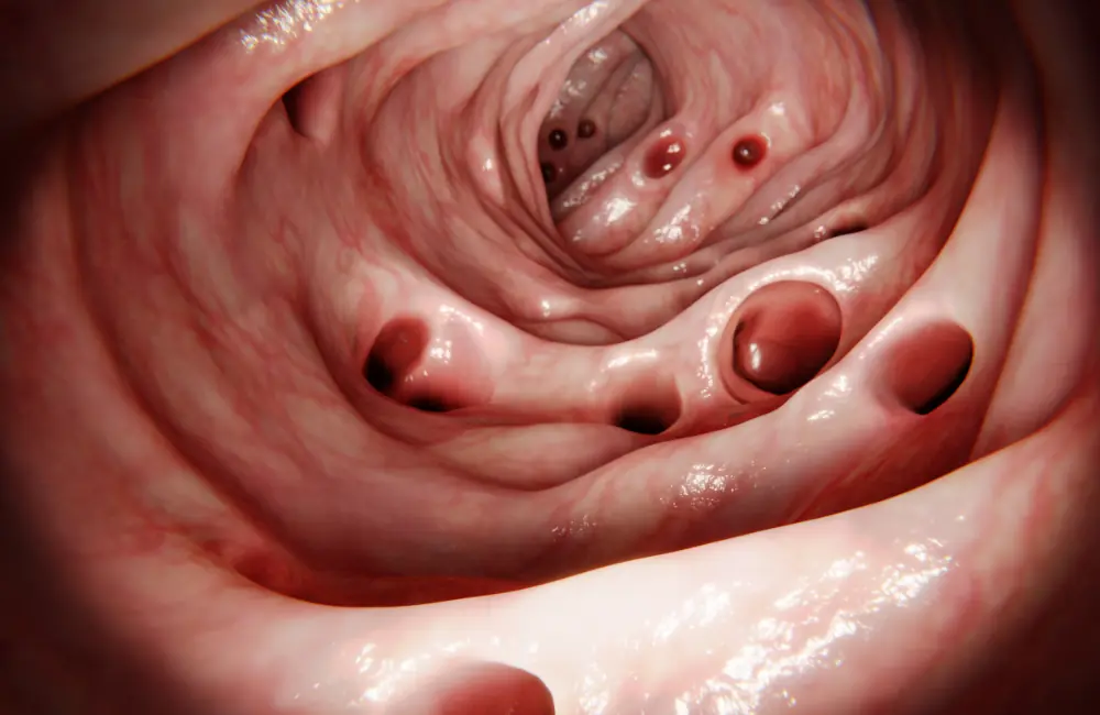 Diverticulite
