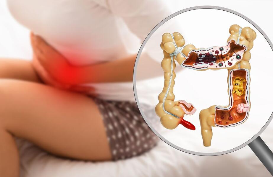 inflamação no intestino