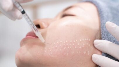 mesoterapia