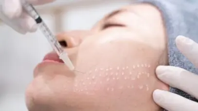 mesoterapia