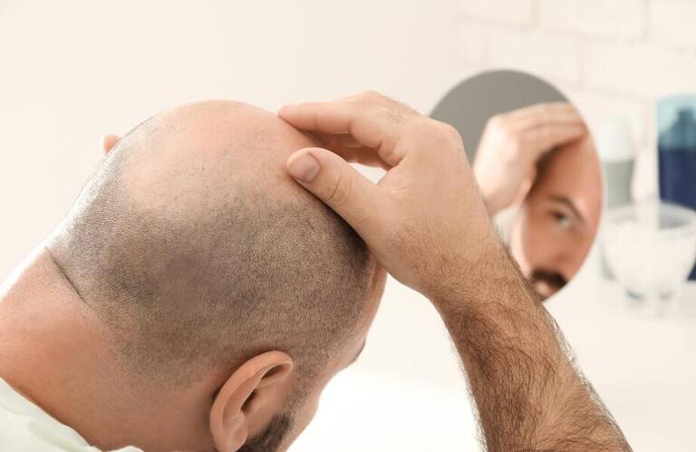 Minoxidil, a solução para o crescimento capilar