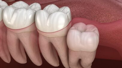 dentes do siso
