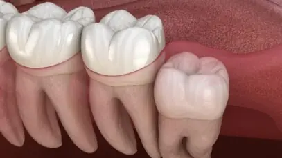 dentes do siso