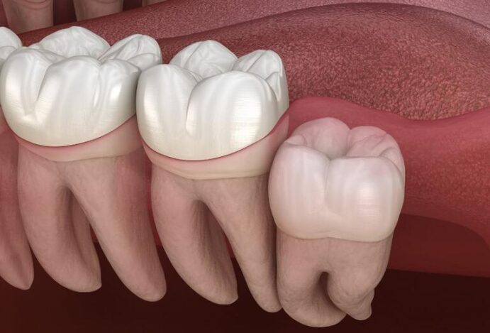 dentes do siso