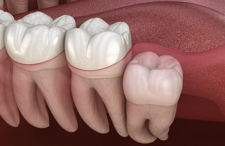 Seis dúvidas sobre dentes do siso