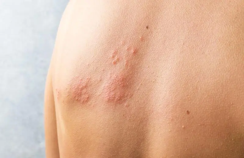 Design sem nome – 2023-07-13T154735.683 Herpes-zóster