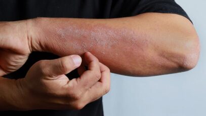 Alergia na pele
