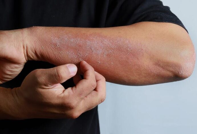 Alergia na pele