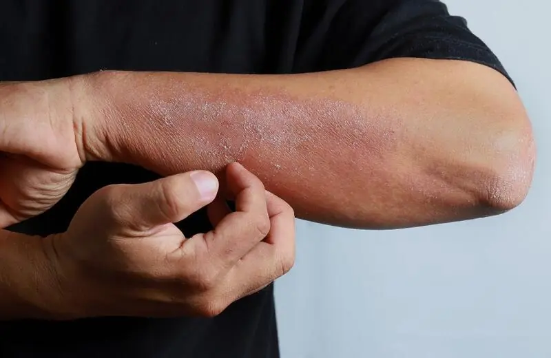 Alergia na pele