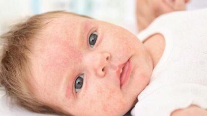 Alergia em bebês