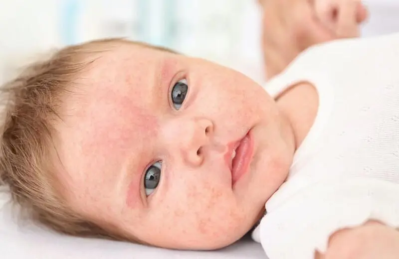 Alergia em bebês