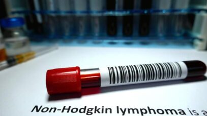 Linfoma