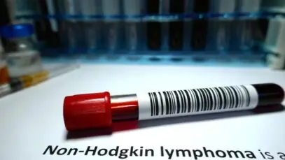 Linfoma