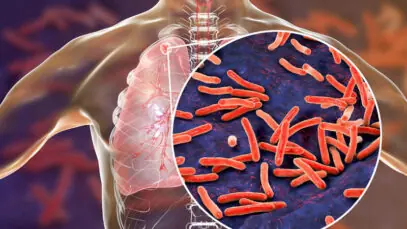 Tratamento da tuberculose