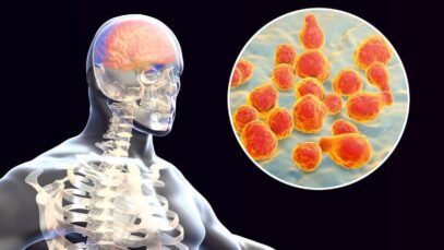 Meningite