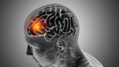 Tumor cerebral