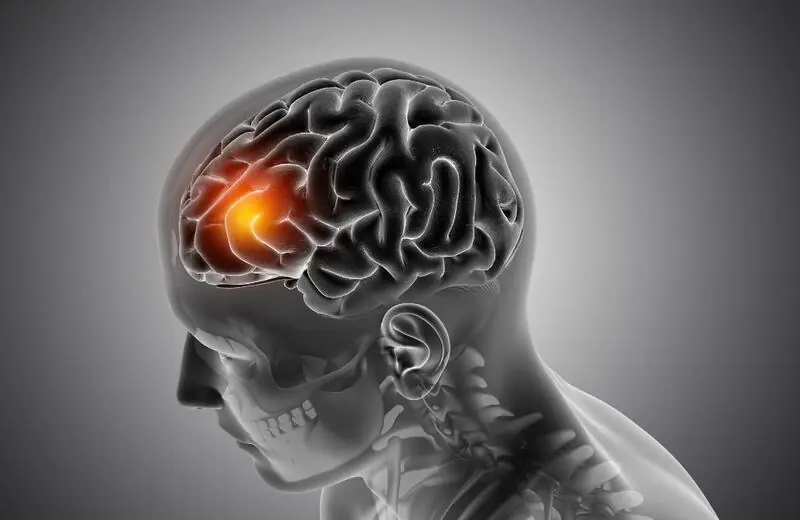 Design sem nome – 2023-10-06T132353.782 Tumor cerebral