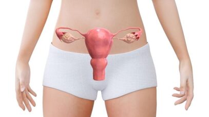 endometriose