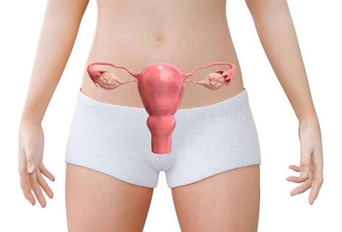 endometriose