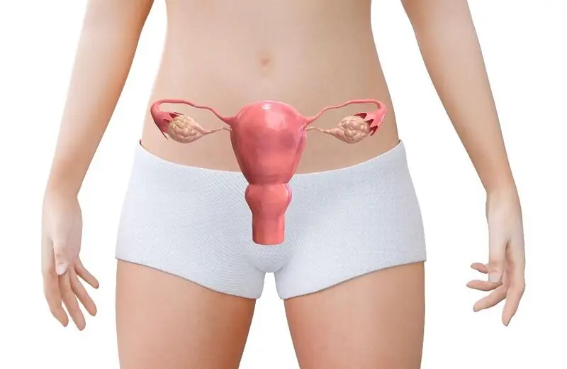 endometriose