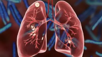 Tuberculose