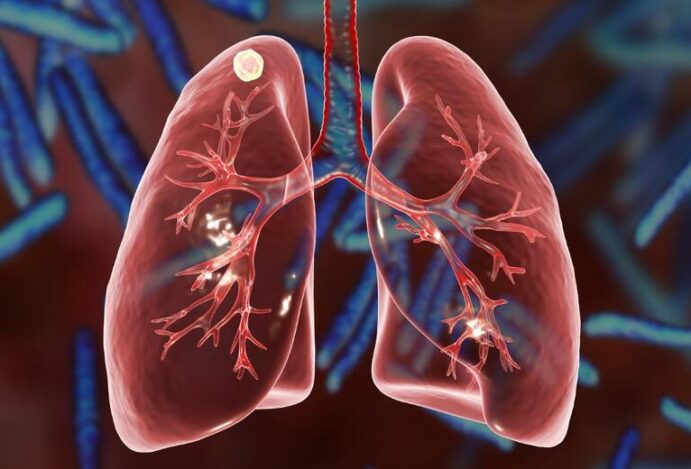 Tuberculose