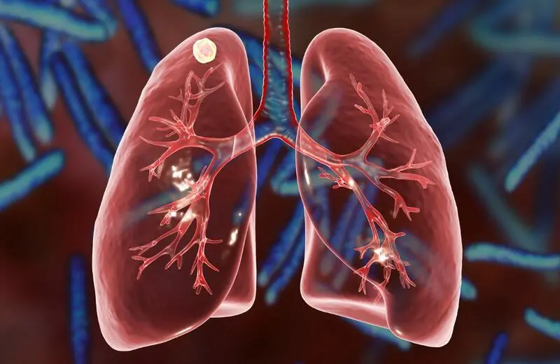 Tuberculose