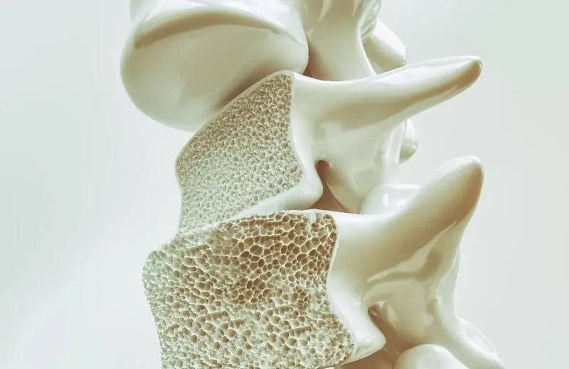Design sem nome – 2023-10-23T131744.002 Osteoporose