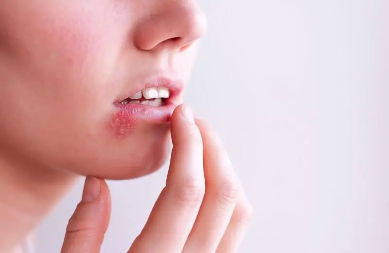Design sem nome – 2023-10-26T123556.547 herpes