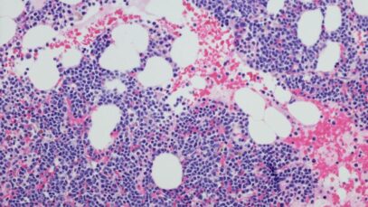 Neoplasia