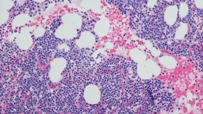 Neoplasia