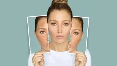 Melasma