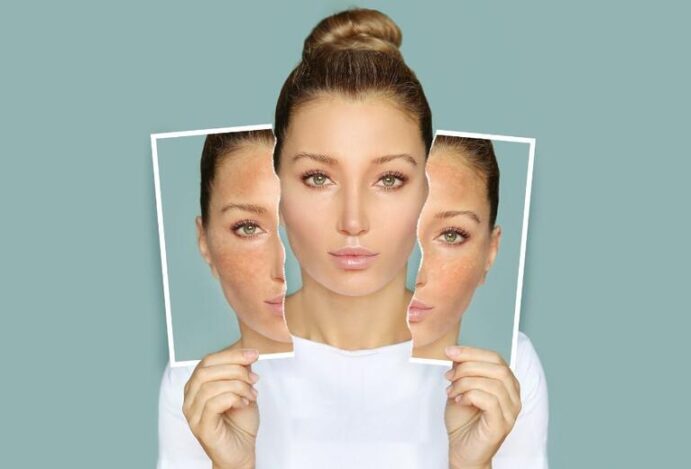 Melasma