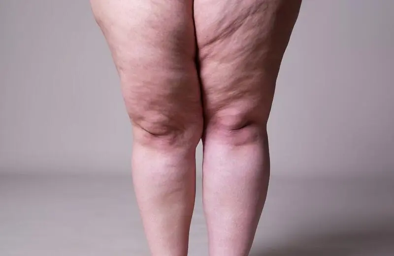 Lipedema