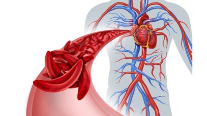anemia falciforme