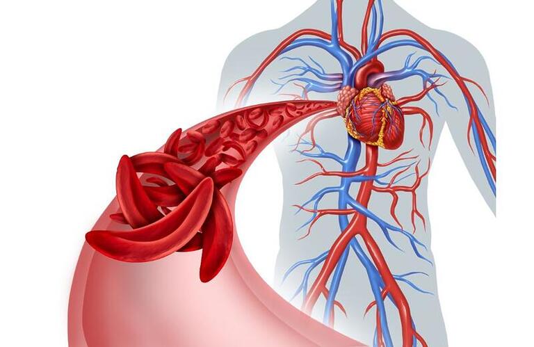 Terapia gênica é aprovada para anemia falciforme
