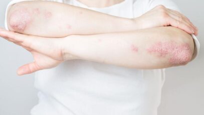 artrite psoriásica