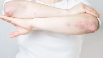 artrite psoriásica