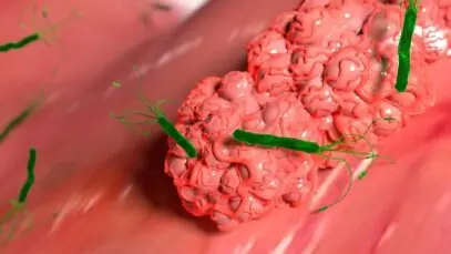 H Pylori